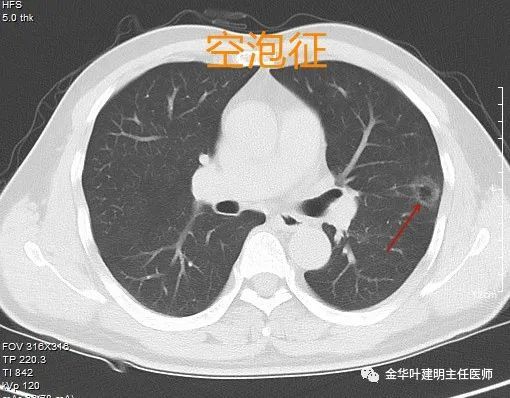 空泡征花朵征:病灶有浅分叶的前提下,又有血管进入,其实是浅分叶与