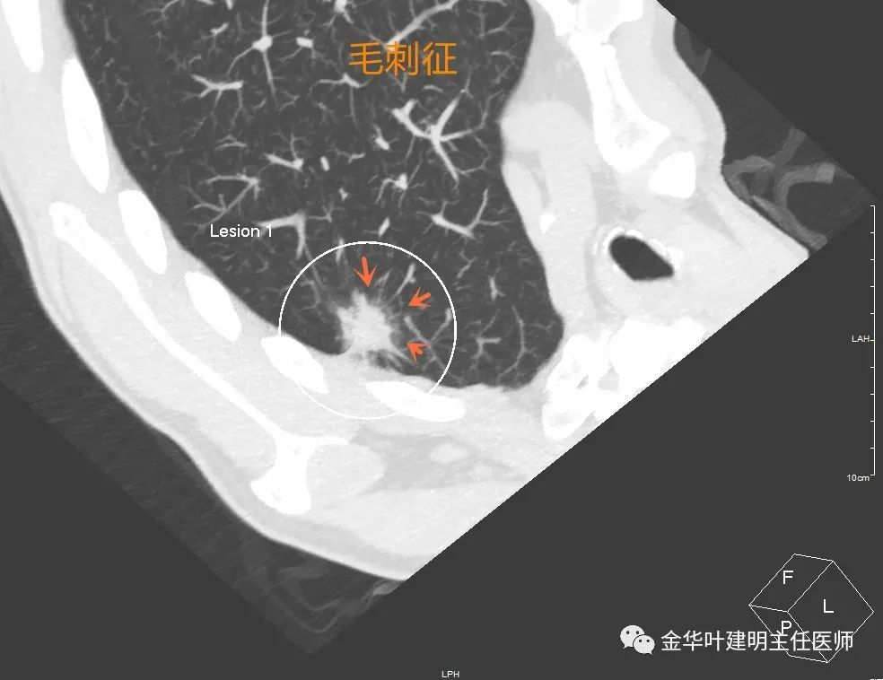 15个常见的恶性肺结节影像特征建议收藏