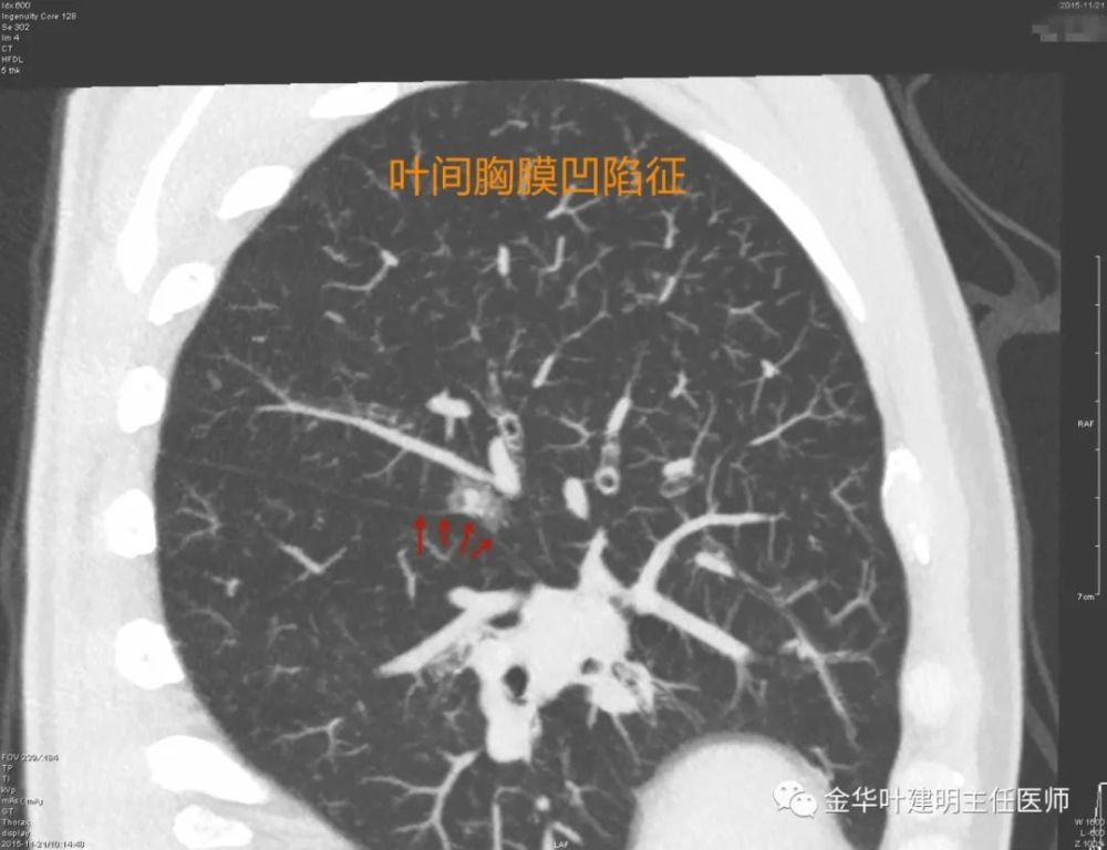 3.31):珍藏-肺结节常见的恶性影像特征汇总