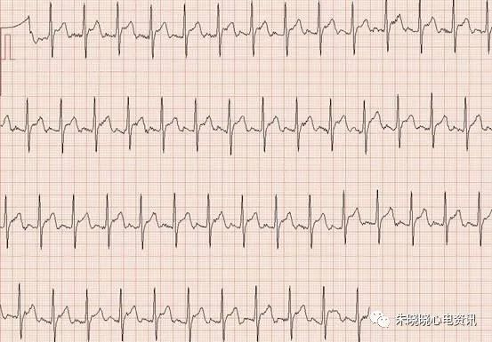 趣味记忆——心律失常心电图
