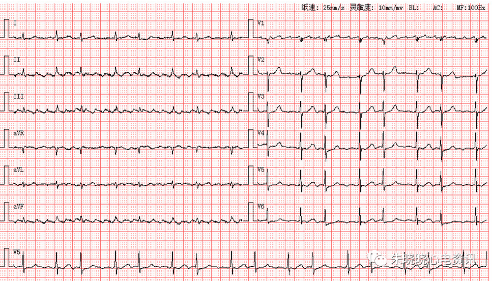 趣味记忆——心律失常心电图