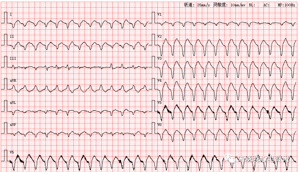 趣味记忆心律失常心电图