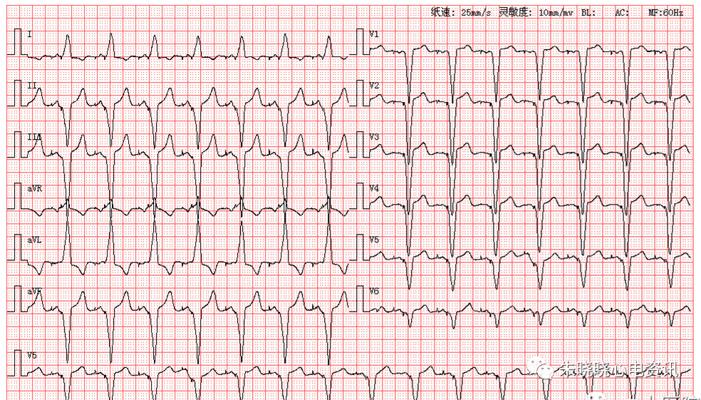 趣味记忆——心律失常心电图