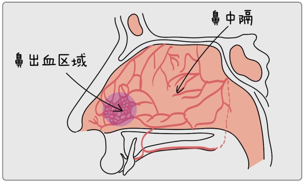 鼻中隔的前下方(利特尔氏区)是毛细血管最丰富的地方,也是最容易出血