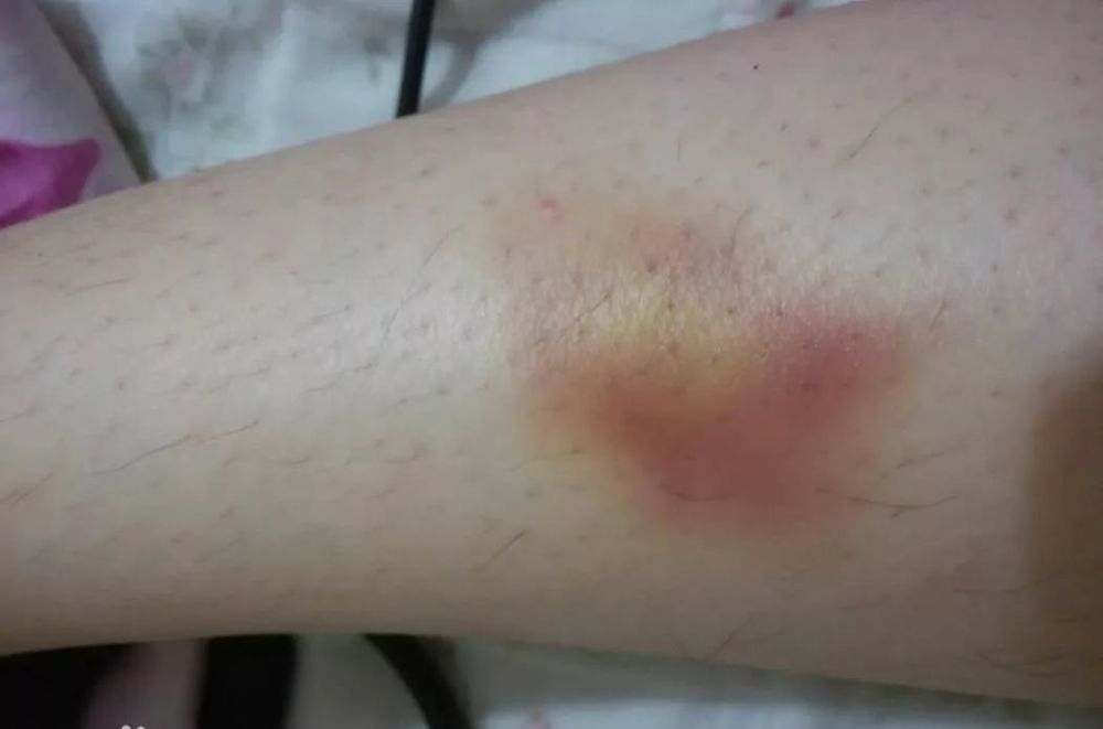 身上总是莫名青一块紫一块 仿佛被人揍了一顿 甚至没有疼痛的感觉 这