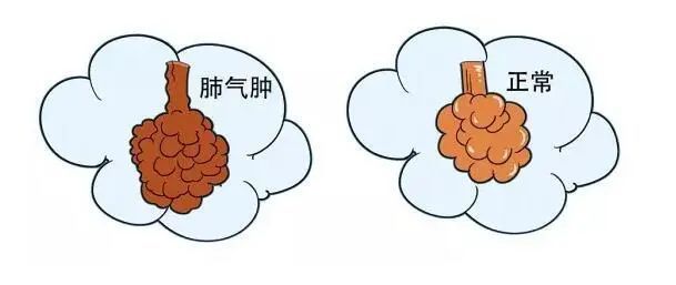 肺气肿的四大体征 腾讯网