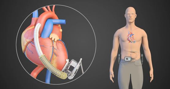 较真丨中国有1300万人心脏衰竭国产人工心脏能帮他们续命吗
