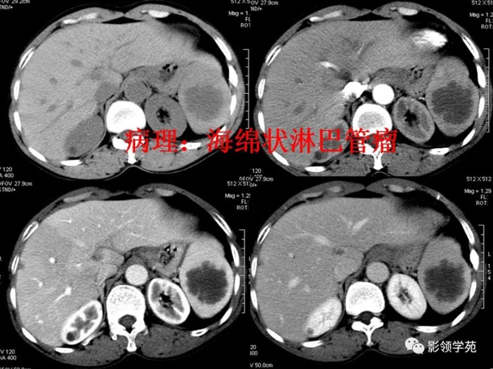 脾脏肿瘤ct诊断