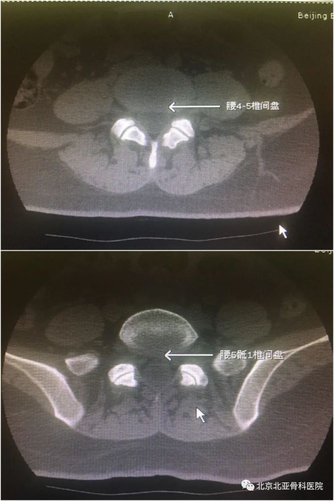 年纪轻轻却腰臀部疼痛难忍原因竟是骶髂关节炎