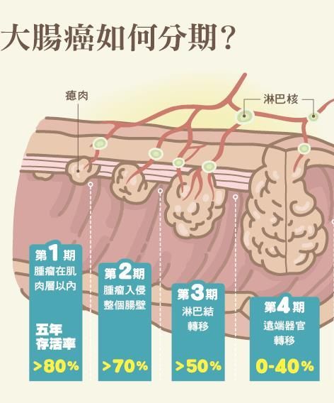 直肠癌的早期症状 有这种症状的人要重视