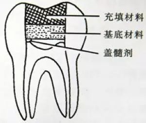 直接盖髓术及其操作后评估