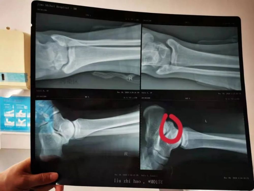 脚踝反复扭伤不一定是韧带拉伤跟距骨桥经常也会有类似的表现