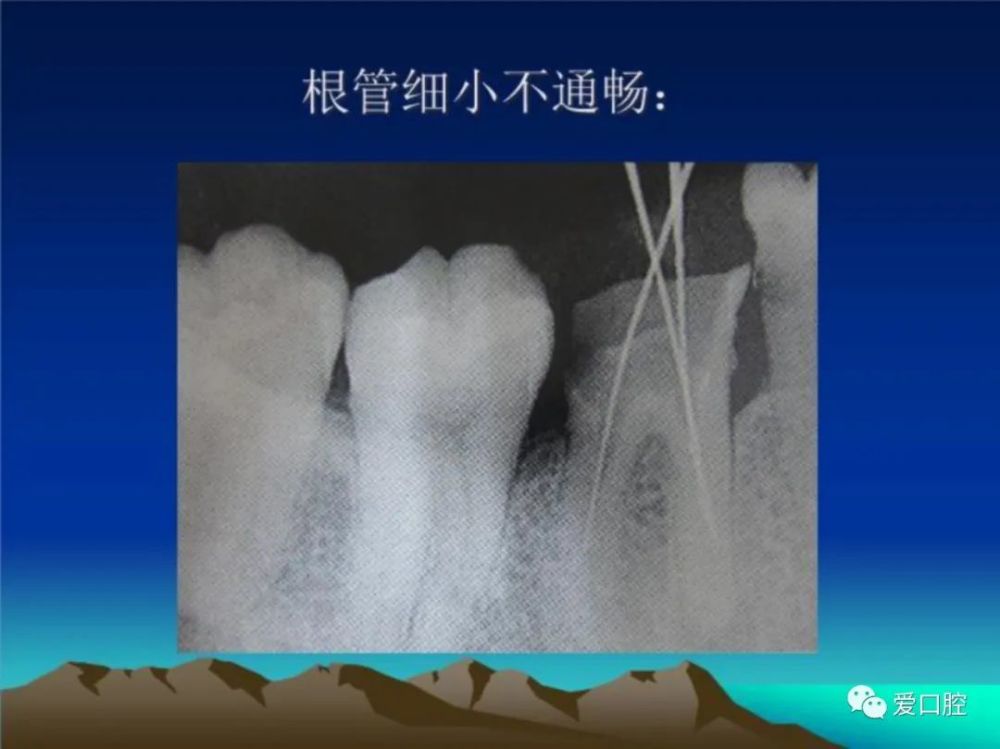 钙化细小根管的处理技巧