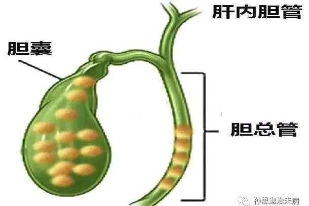 胆囊结石,特别是胆囊内的小结石,会随胆汁排空进入胆总管,成为胆总管