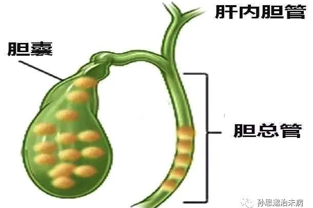 诱发急性胆管炎,胆总管结石