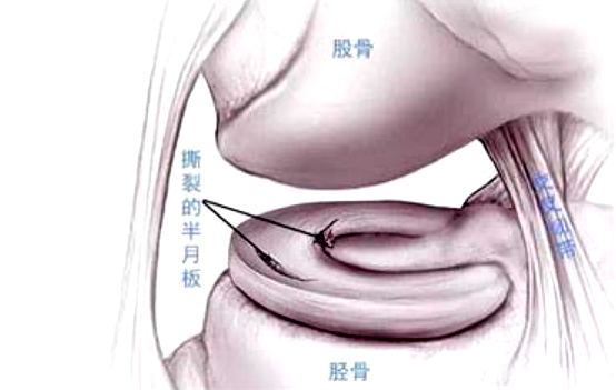 关于半月板的常见问题与解答