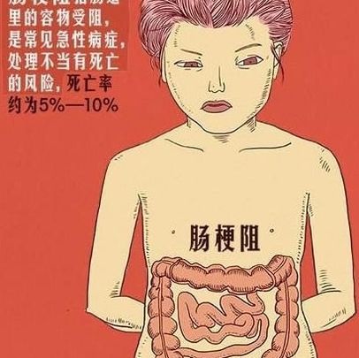 肠梗阻治疗不及时会致命医生提醒出现这些症状请马上就医