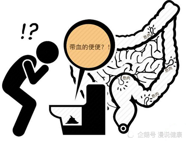 直肠癌早期毫无征兆?医生劝告:排便有4种"征兆",别拖