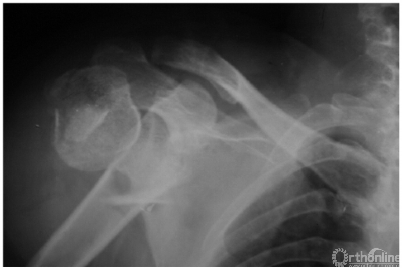 骨科常见疾病x线解析之肩关节骨折与脱位