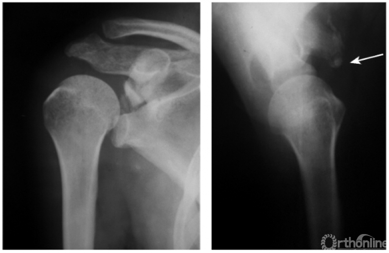 骨科常见疾病x线解析之肩关节骨折与脱位