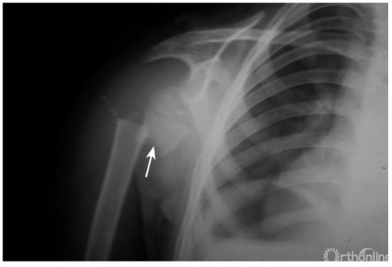 例5:肩关节喙突下脱位并外科颈劈裂骨折及同侧锁骨中断骨折(如下图).