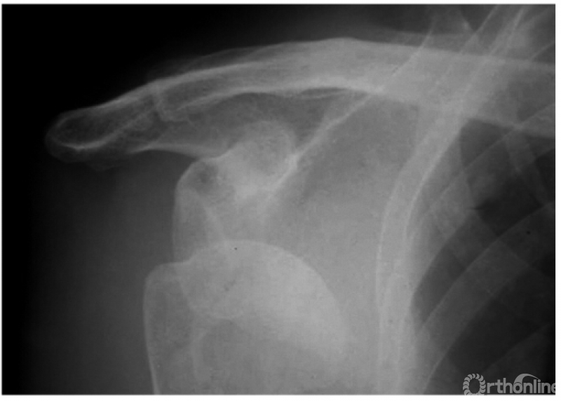 骨科常见疾病x线解析之肩关节骨折与脱位