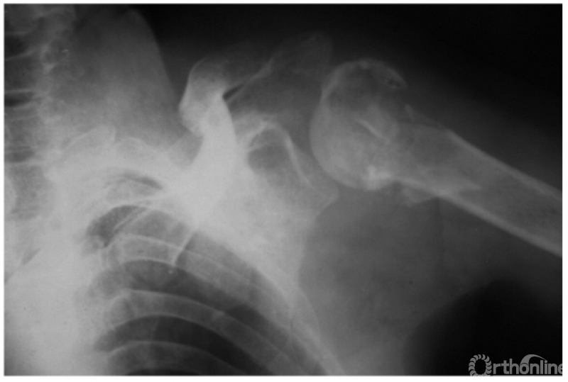 例2:肩关节轻度向后旋转脱位并解剖颈骨折,大结节分离及锁骨骨折(如
