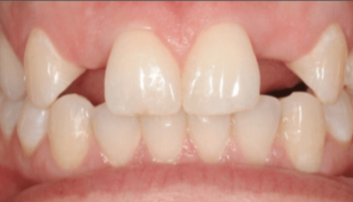 一部分或者所有正常的牙齿未能发育和形成,则称为先天性缺牙.