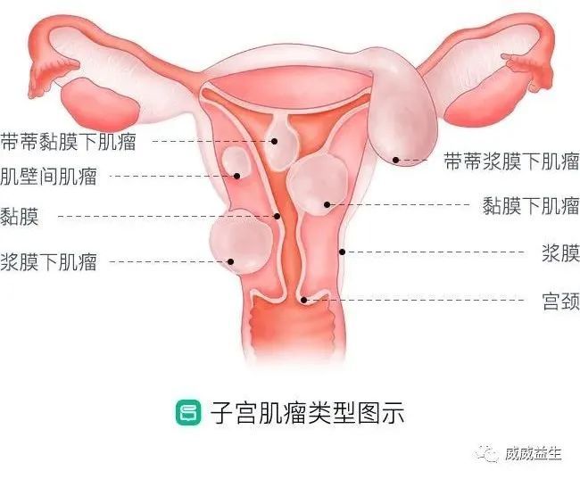 得了子宫肌瘤,就一定要切除子宫么?