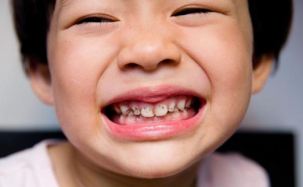 孩子3岁没吃过糖,一张嘴满口蛀牙,医生检查后表示:错