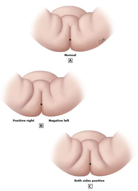 孩子大腿皮纹,臀纹不对称,可能影响走路,快观察!