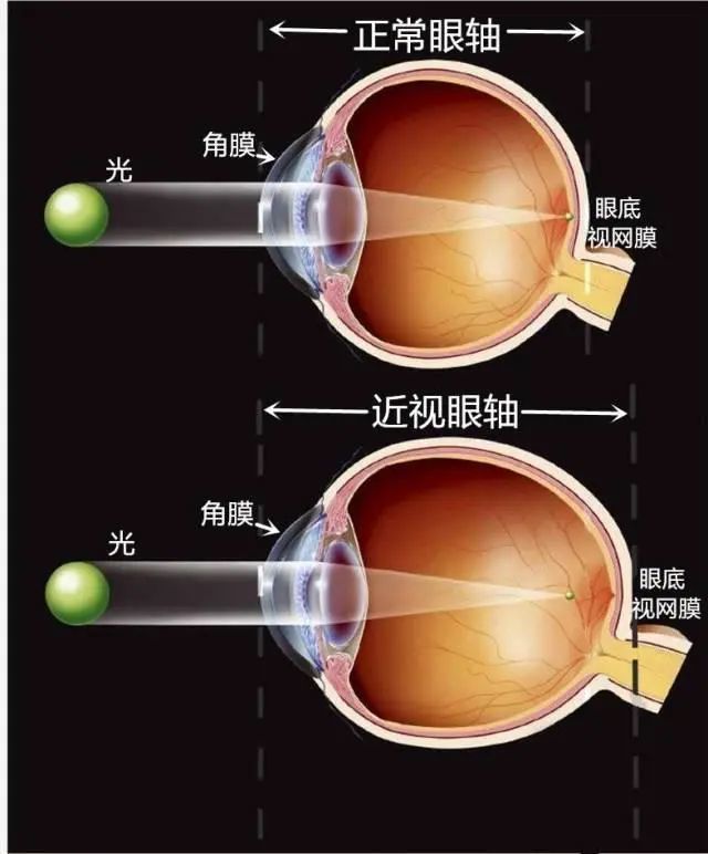 正常眼球和近视眼对比示意图