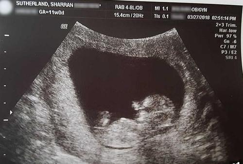 宝妈怀孕14周流产网上分享胎儿照片仅10厘米但手脚都已成型
