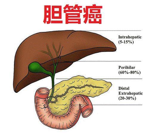 黄俭主任老中医说癌症 第1期:胆管癌的早期症状有哪些