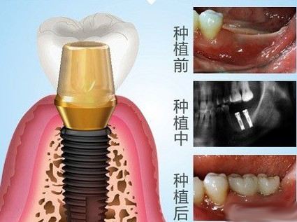 种植牙|牙齿|假牙