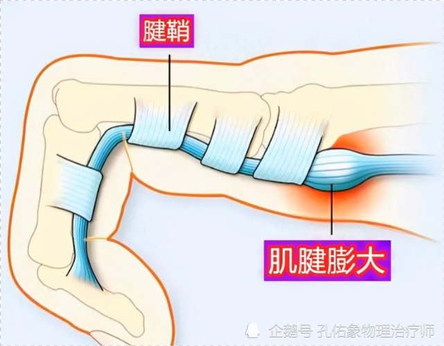 形成一个球状的膨大;当肌腱通过腱鞘时遇到阻碍,一旦用力把指头伸直