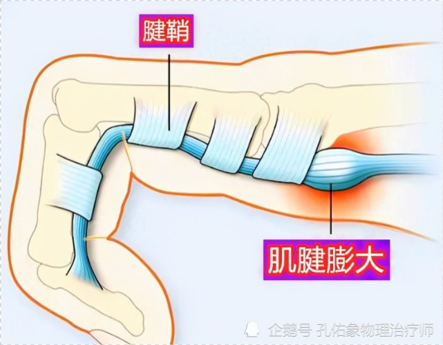 中老年女性常患有腱鞘炎应该怎么办医生告知您详细的治疗方法