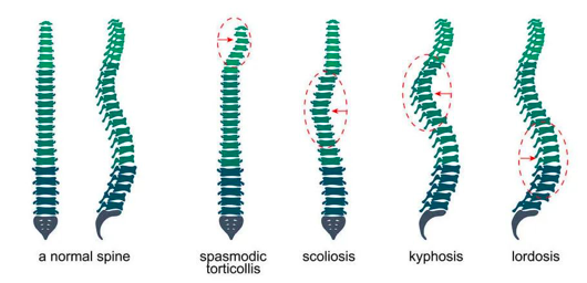 "成长杀手"脊柱侧弯,3 个方法科学自测!90% 的孩子不合格
