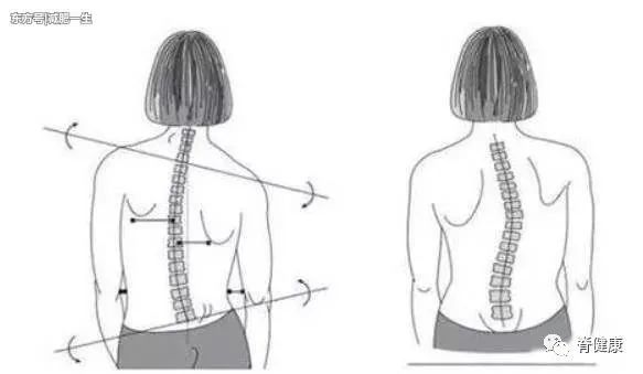 脊柱侧弯有多恐怖?赶紧来看看!吓得我立马坐直了