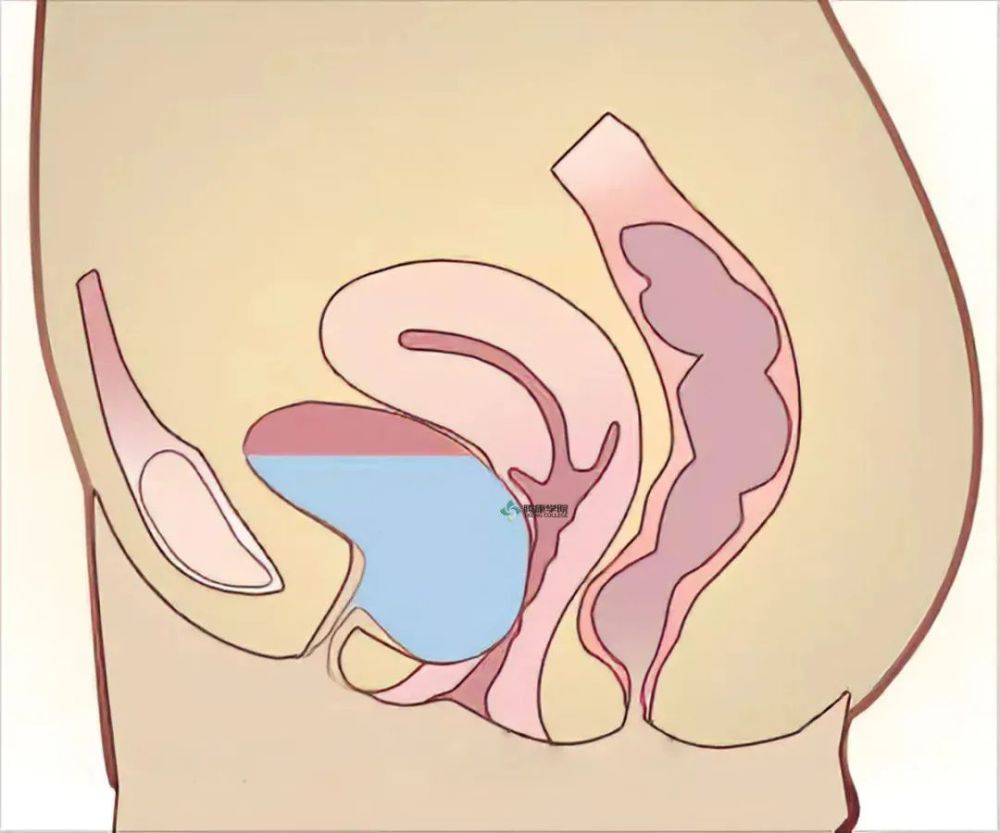 分娩损伤是导致膀胱膨出最常见的病因,分娩时支托组织及软产道极度
