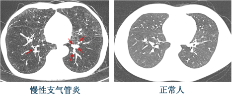 慢性支气管壁增厚
