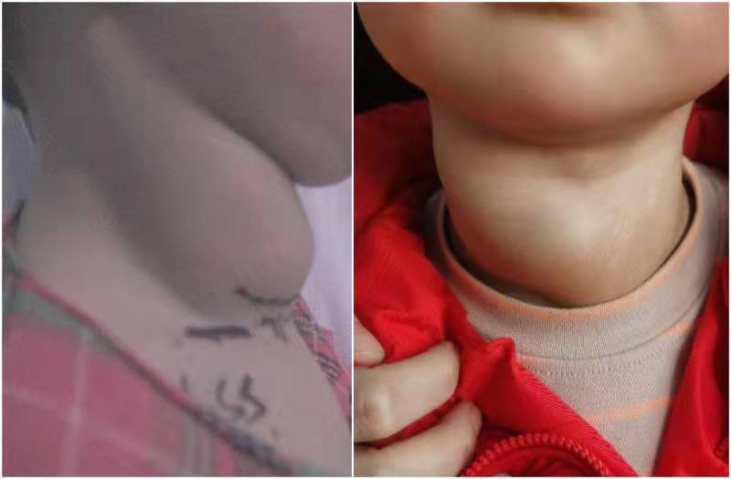 3岁女童患甲状腺癌少年儿童发病率上升