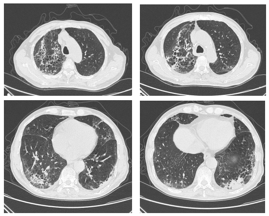 出院第二十天胸部ct,两肺间质性炎症,两肺肺气肿.