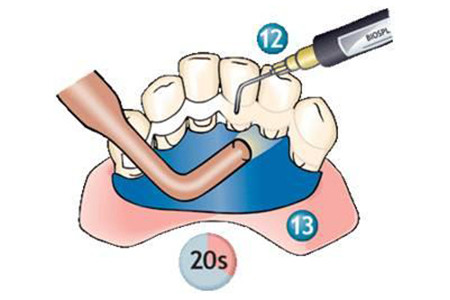 理想的牙周夹板应具备的以下条件: 固位力强,固定效果良好,能抵御