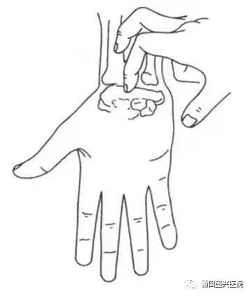 神经叩击实验(tinel征):用手指轻叩腕部,如出现正中神经支配区异常感