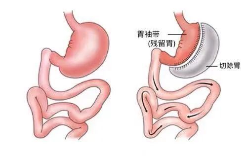 被骂上热搜的 "切胃"手术,你考虑过吗?