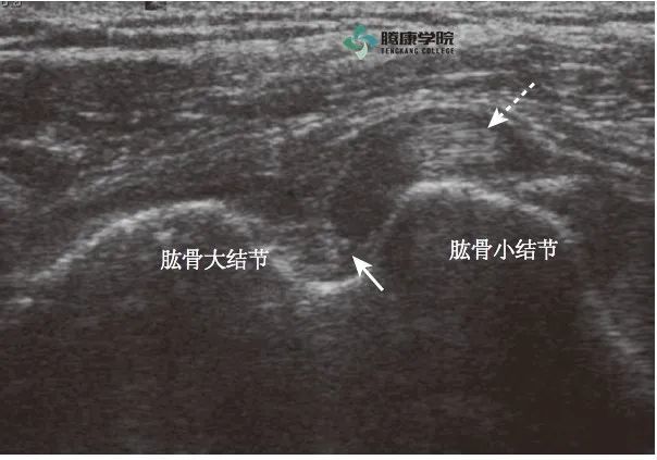 轴位像显示结节间沟内肌腱缺失(箭头所示),该患者也有明显的肩袖撕裂