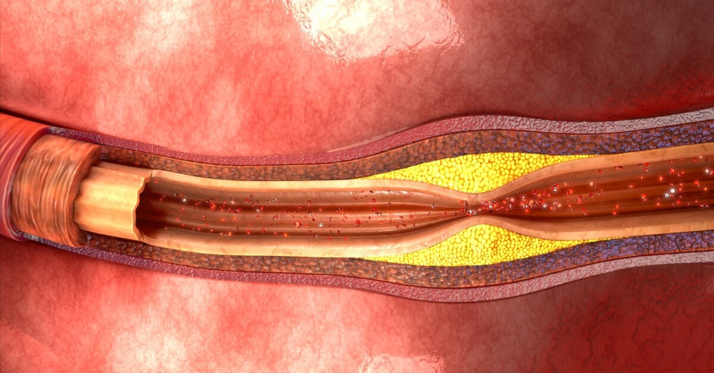 颠覆认知!动脉粥样硬化的新机制被找到了,有望研发出心血管新药