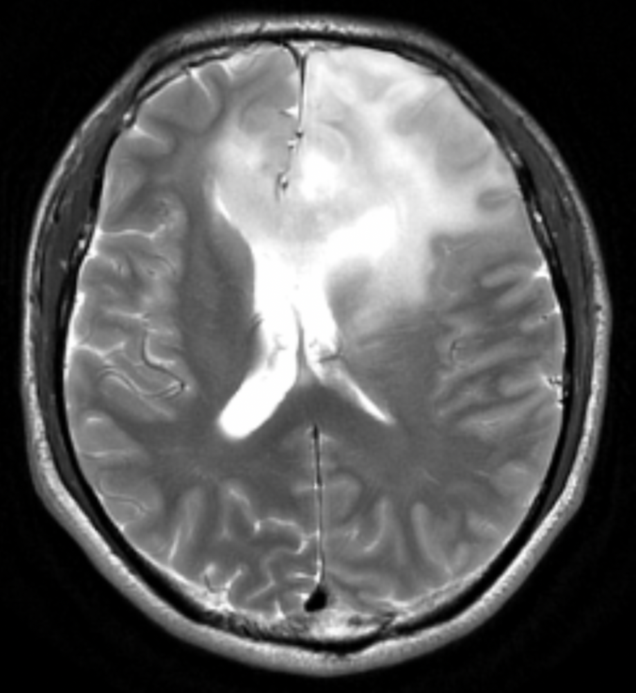 磁共振图片显示左额叶胶质瘤