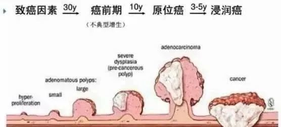 误把肠癌便血当痔疮,医生提醒:通过5点来分辨,早诊断早安心